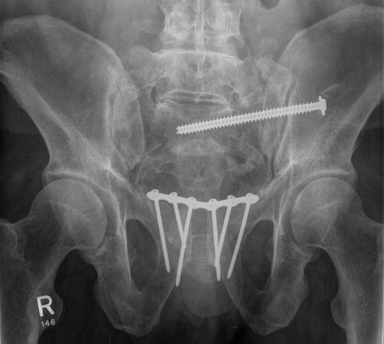 Pelvis Pubic Symphysis Plate 2